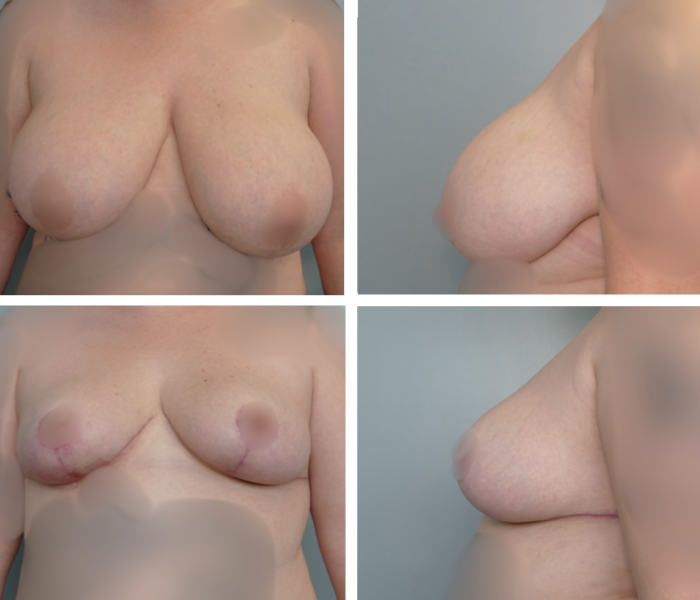 Breast reduction before and after results